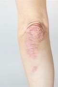 Image result for Psoriatic Arthritis