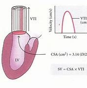 Image result for Left Ventricular Outflow Tract Stroke Volume