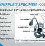 Image result for Whipple Specimen Gross Pathology