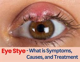 Image result for Stye Symptoms