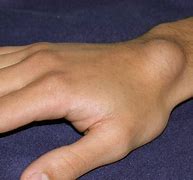 Image result for Ganglion Cyst in Capitate