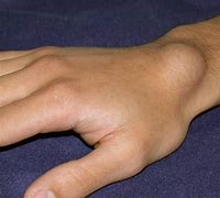 Image result for Cyst On Wrist