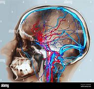 Image result for Brain MRI Angiogram