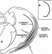 Image result for Ilioinguinal Nerve Sensory