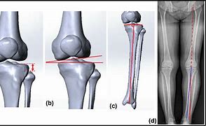 Image result for Deformity of Fibular Head