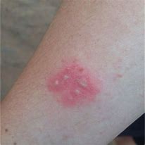 Image result for Skin Rash with Pustules