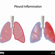 Image result for Pleural Infection