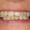 Image result for Bottom Dentures