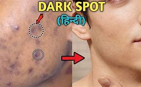 Image result for Black Pimple On Face