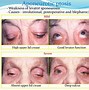 Image result for Ptosis Nerve Damage