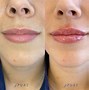 Image result for Hylauronic Pen Lip Filler