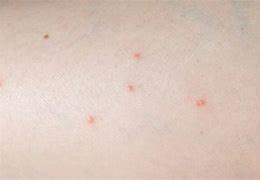 Image result for Spider Rash