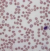 Image result for Uremic Anemia