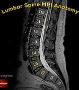 Image result for C-spine MRI