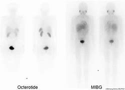 Image result for MIBG Pheochromocytoma