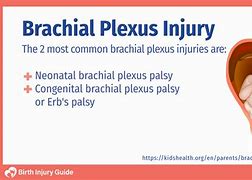 Image result for Brachial Plexus Injury