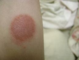 Image result for Circular Rash On Skin