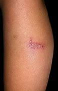 Image result for Lower Leg Pustules