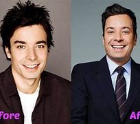 Image result for Jimmy Fallon Plastic Surgery