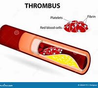 Image result for What Is a Thrombus