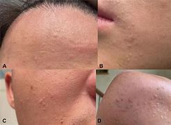 Image result for Flat Warts On Eyelids