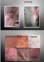 Image result for Pustules Skin Disease