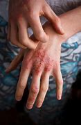 Image result for Eczema On Hands