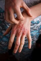 Image result for Eczema Rash On Hands