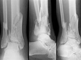 Image result for Surgical Approach of Pilon Fracture