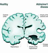 Image result for ALZ Disease