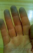 Image result for Cyanosis