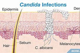 Image result for Candida Face