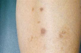 Image result for Dark Age Spots On Legs