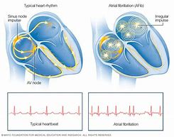 Image result for Atrial Arrhythmia