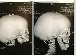 Image result for Guy Missing Jaw