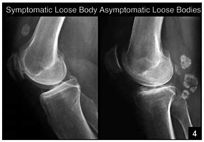 Image result for Posterior Knee Loose Bodies