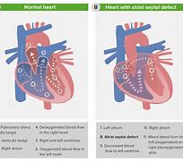 Image result for Atrial Septal Defect Blood Flow