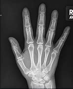 Image result for PA Finger X-ray