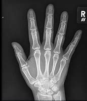 Image result for Normal Hand Radiograph