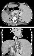 Image result for Spleen Enlargement CT