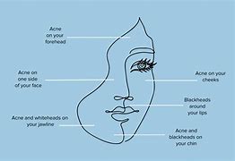 Image result for Acne On Side of Face