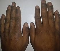 Image result for Eczema On Darker Skin