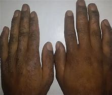 Image result for Eczema On Black Skin with Grey Colour