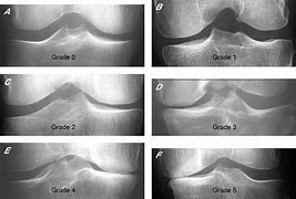 Image result for Patellofemoral Joint Space Narrowing