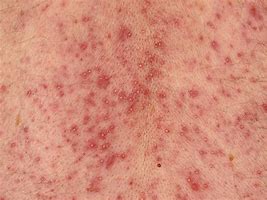 Image result for Skin Rash with Pustules