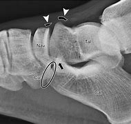 Image result for Chopart Fracture