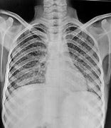 Image result for Miliary Tuberculosis Chest X-ray