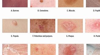 Image result for Pustule Skin Lesion