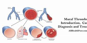 Image result for What Is a Thrombus