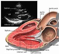 Image result for Right Parasternal View Echo